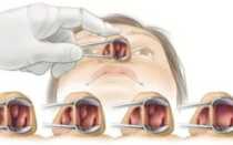 Острый синусит, аденоиды 1-2 степени