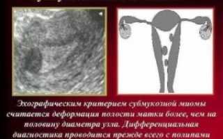 Миома с деформацией полости матки