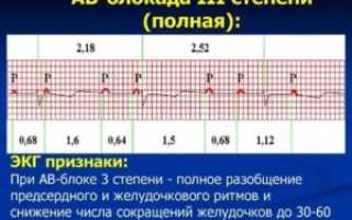 АВ блокады при беременности