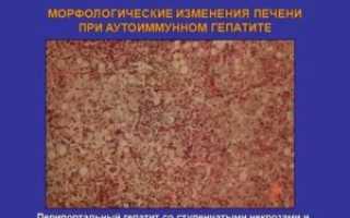 Перипортальные изменения печени