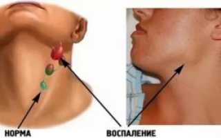 Температура и увеличение лимфоузлов