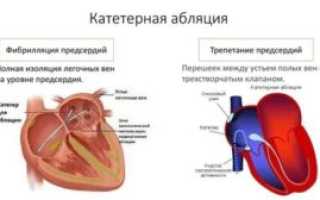После абляции устьев лёгочных вен мучает экстрасистолия и тахикардия