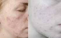 Много прыщиков после приёма Белары