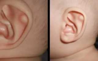 Шишка в ухе у грудничка