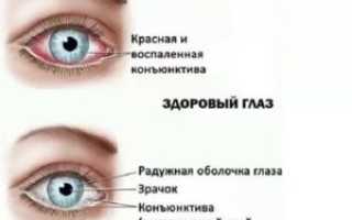 Покраснел глаз не коньюктивит