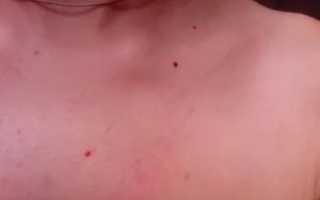 Красные точки на шее и груди