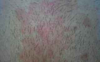 Шелушение и зуд на лобке