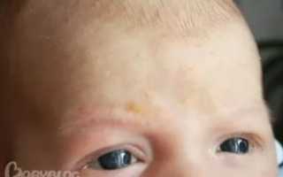 Желтоватые пятна на лбу ребенка