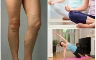 Спорт при тромбофлебите
