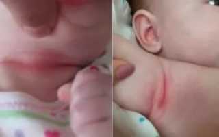Синехии у грудничка
