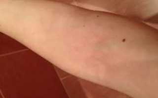 Красное пятно на вене