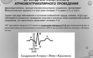 Ускоренная AV проводимость у беременных