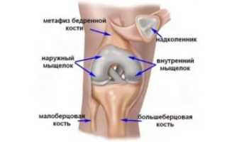 Травма колена, контузионные изменения бедренной кости