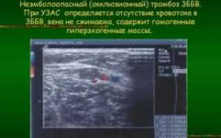 Окклюзионный тромбоз, тромбоз ЗББВ