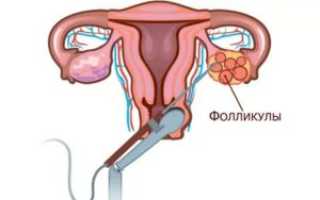 Киста яичников, эко