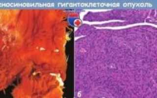 Тендосиновиальная гигантоклеточная опухоль