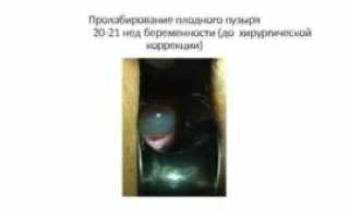 Пролабирование плодного пузыря