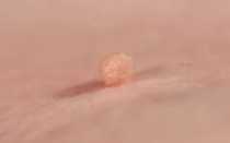 Остроконечные кондиломы у ребёнка