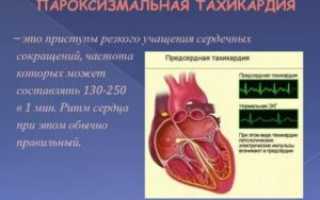 Приступы тахикардии участились