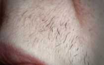 Раздражение и вросшие волосы