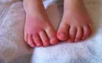 Опухший пальчик на ноге у ребенка