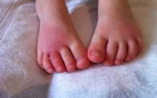 Опухший пальчик на ноге у ребенка