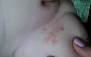 Сыпь у ребенка между ног