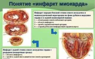 Рубец на стенке желудочка
