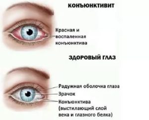 Покраснел глаз не коньюктивит