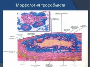 Очаговая пролиферациям трофобласта