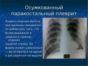 Локальное утолщение паракостальной плевры слева