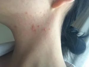 Гнойные прыщи на шее