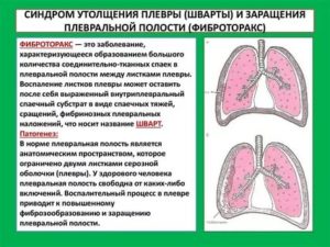Локальное утолщение паракостальной плевры слева