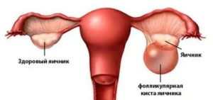 Фолликулярная киста и овуляция