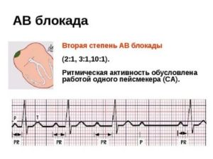 АВ блокады при беременности