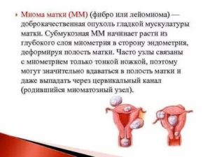 Миома с деформацией полости матки