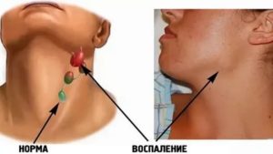 Температура и увеличение лимфоузлов