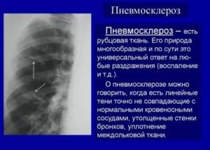 Может ли пневмосклероз привести к раку легкого?