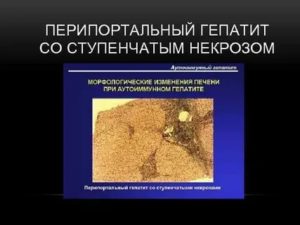 Перипортальные изменения печени
