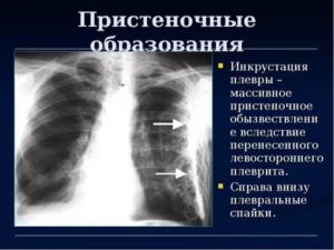 Локальное утолщение паракостальной плевры слева