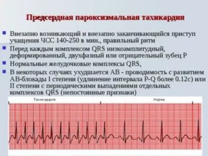 Приступы тахикардии участились