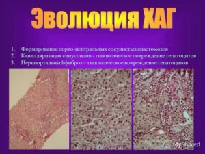 Перипортальные изменения печени