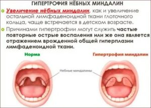 Лимфоидная ткань после тонзиэлактомии