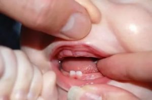 Осиплость голоса и прорезывание зубов