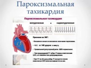 Приступы тахикардии участились