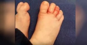 Опухший пальчик на ноге у ребенка