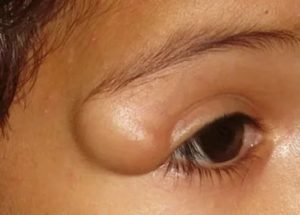 Шишечка под бровью