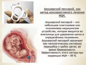 ИЦН при двойне с пессарием