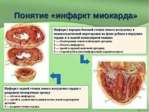 Рубец на стенке желудочка
