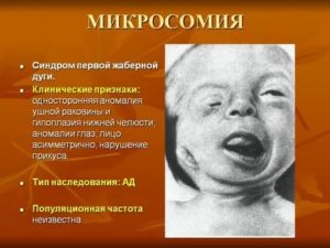Синдром жаберных дуг и рождение хдорового ребенка